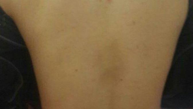 Sırtımda cıkan sivilceler neyin habercisi? Fotografa bakabılır mısınız?
