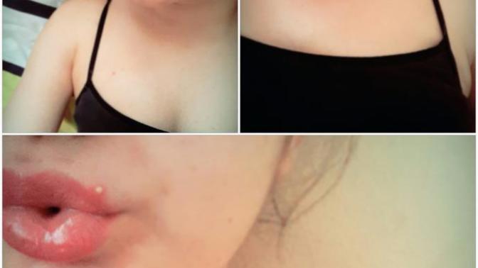 Dudağımda bir şey çıktı.Nasıl geçer?