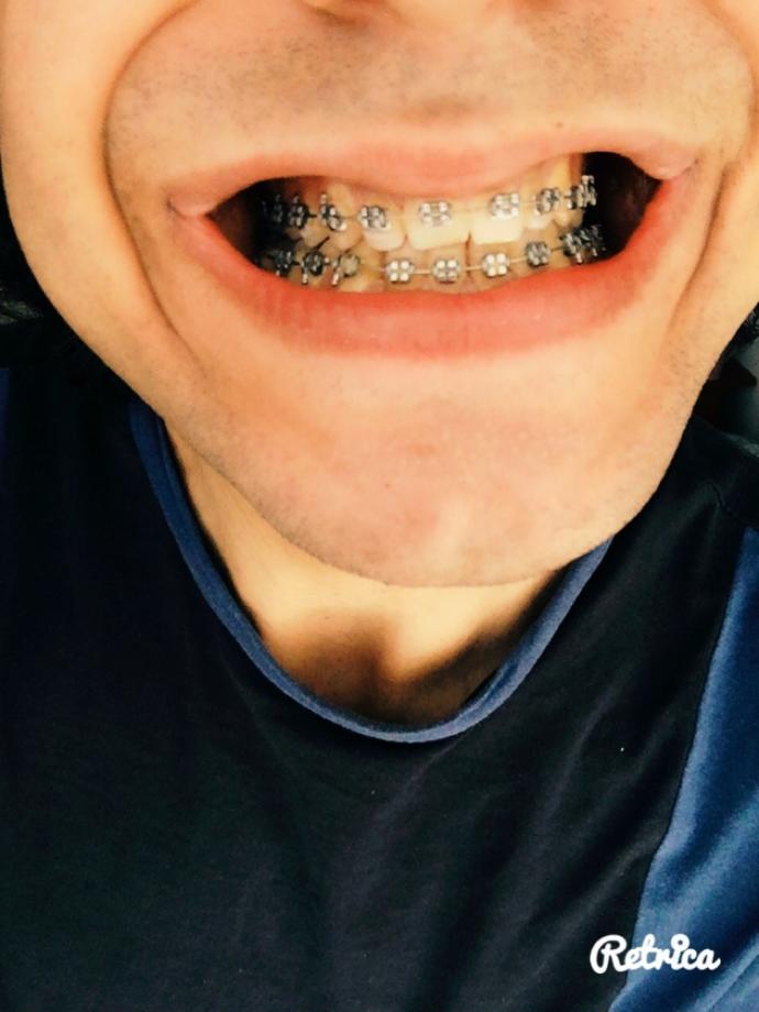 Diş tellerimin çıkma vakti gelmiş mi?