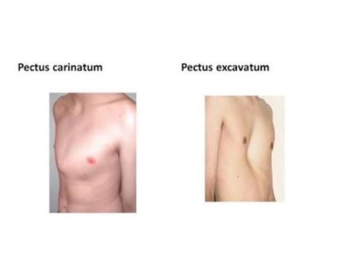 pektus karinatum ameliyatı olan var mı ?