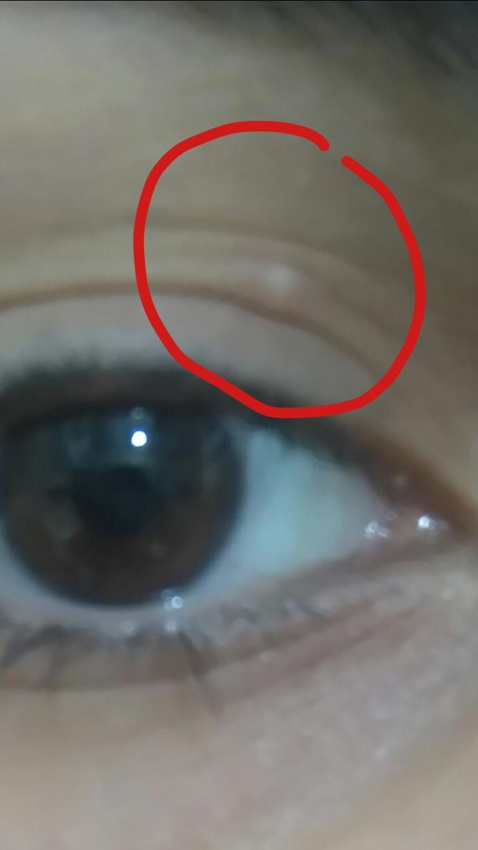 Göz kapağımda çıkan şey ne?