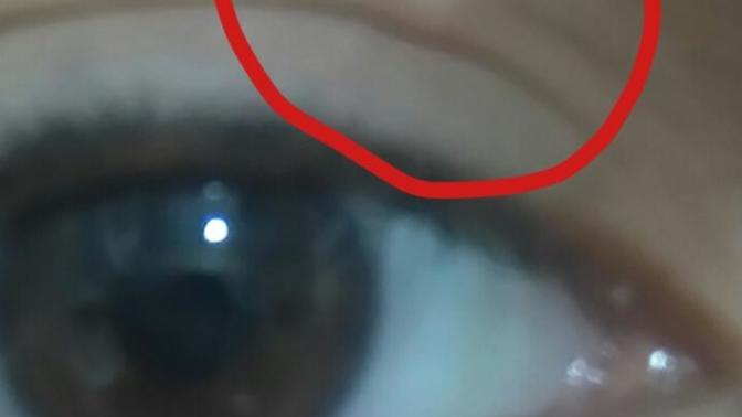 Göz kapağımda çıkan şey ne?