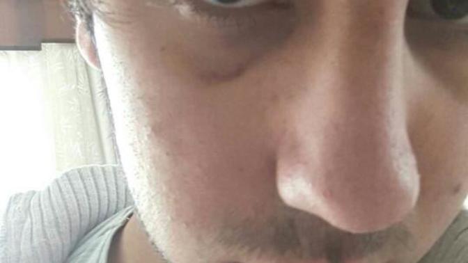 Göz altındaki morluk ne kadar sürede geçer?