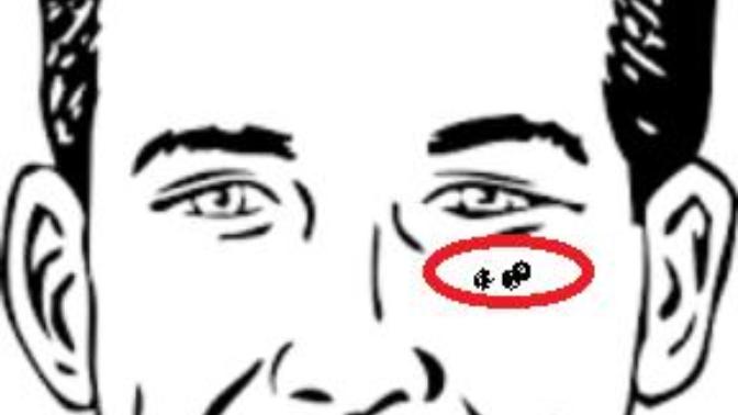 Gözümün altında bile sakal çıkıyor bu normal mi?