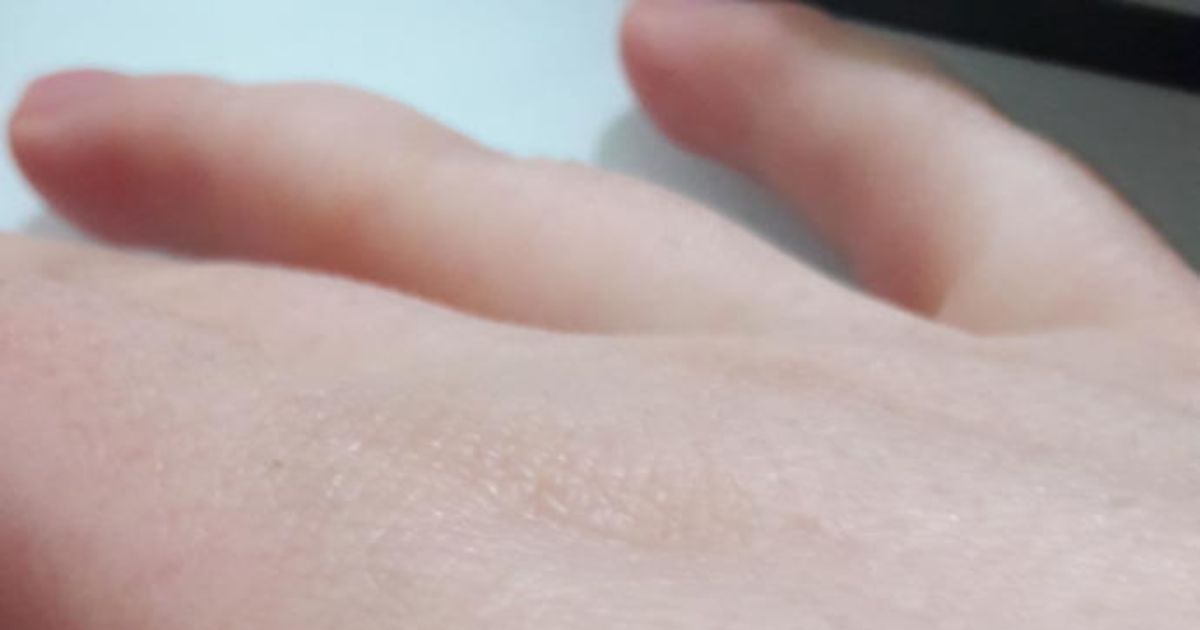 Elimdeki bu yara nasil geçer? - KizlarSoruyor