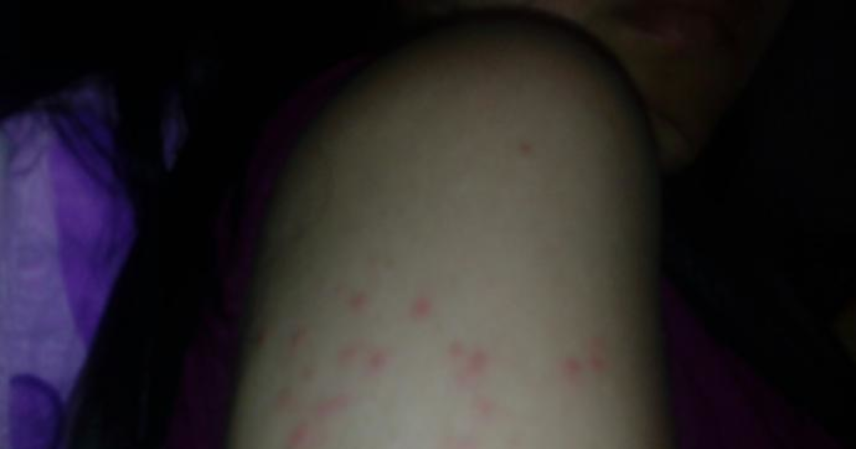 kollardaki sivilceler kizlarsoruyor