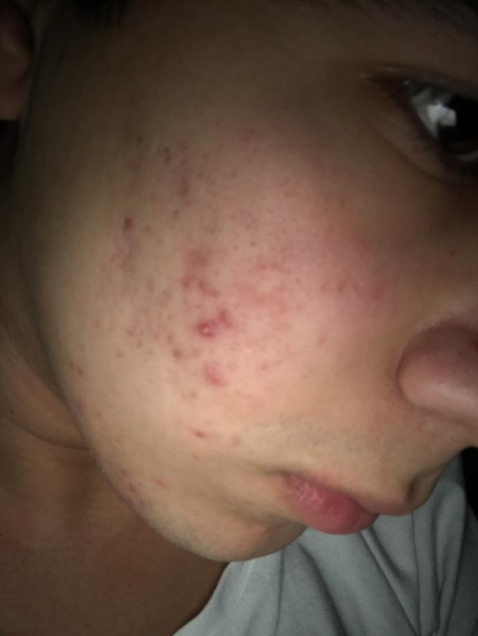 ROACCUTANE SONRASI KALAN İZLER?