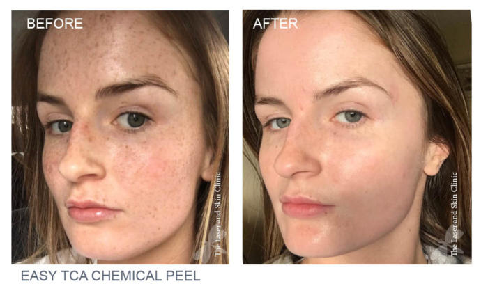 Tca peeling kullanan var mı?