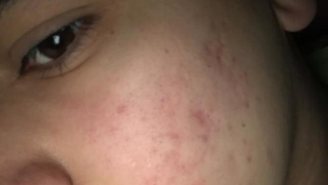 Tca peeling kullanan var mı?