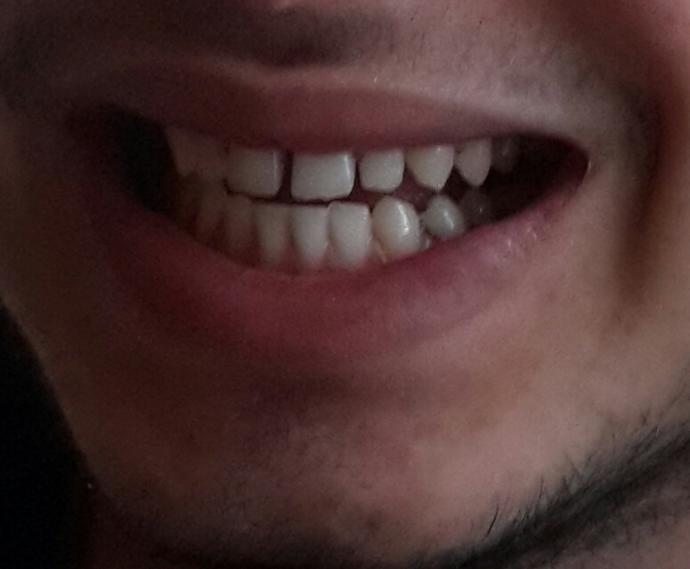 Dişlerim çok mu ayrık diş teli gerekiyor mu ?
