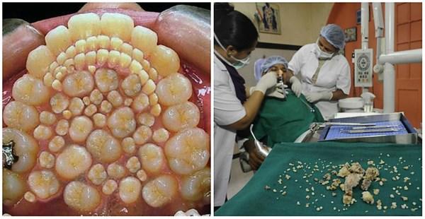Odontoma Nedir?