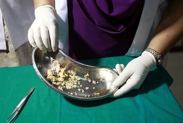 Odontoma Nedir?