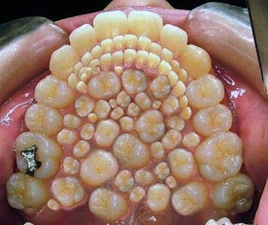 Odontoma Nedir?