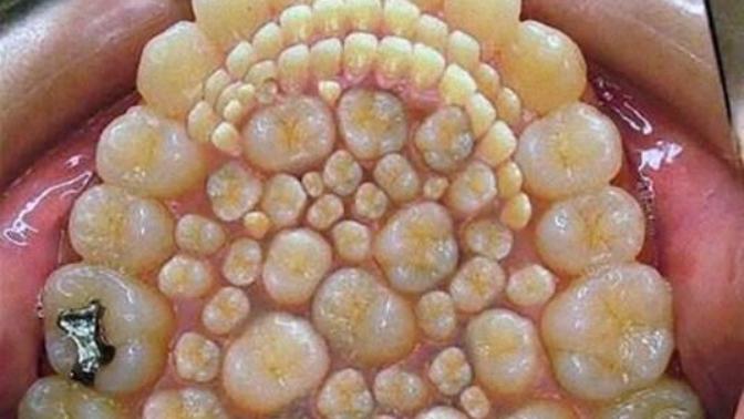 Odontoma Nedir?