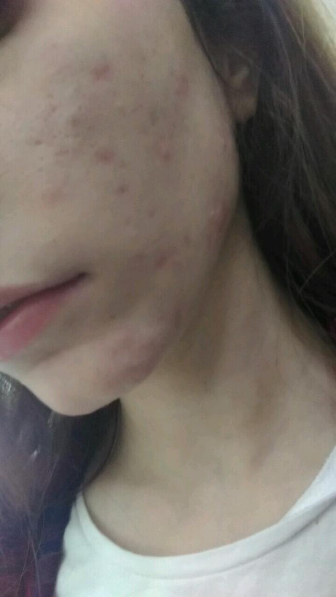 roaccutane ile ilgili bir soru sorucam yardim eder misiniz lutfen?