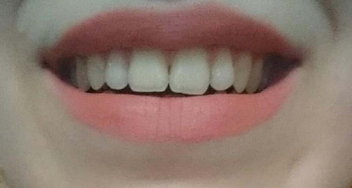 Dişlerim sizcede çok sarı değil mi sizce ne yapmalıyım şu White now'un yeni çıkardığı kalemi deneyen var mı?