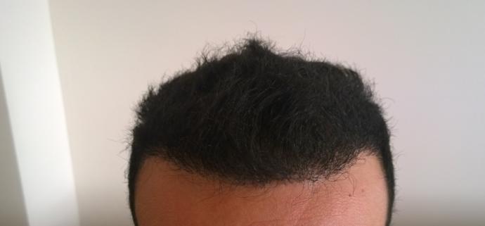 Saç ektirdim, çok belli oluyor mu? Ekim öncesi ve sonrası için yorumlarınızı alabilir miyim?