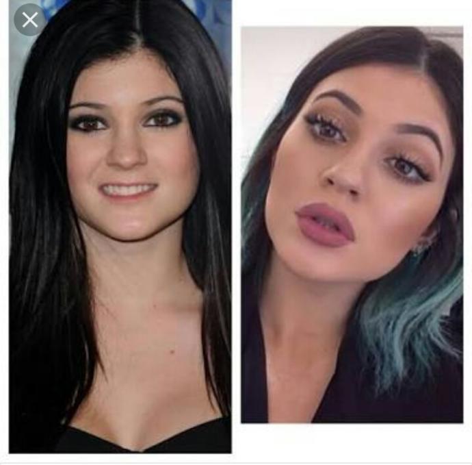 Dudak silikonu?