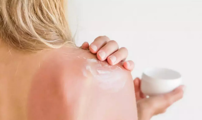 Solaryum Yanığı/Kızarıklığı Nasıl Geçer?