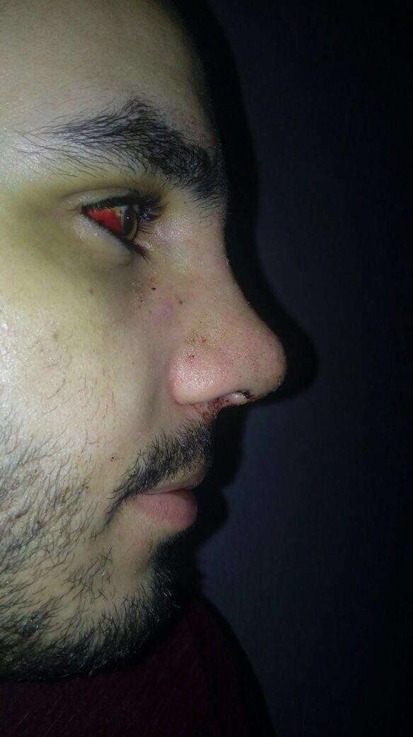 Burnuma estetik yaptırdım görüşlerinizi alayım 🙊 ?