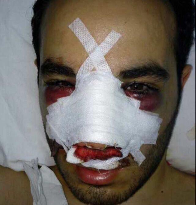 Burnuma estetik yaptırdım görüşlerinizi alayım 🙊 ?