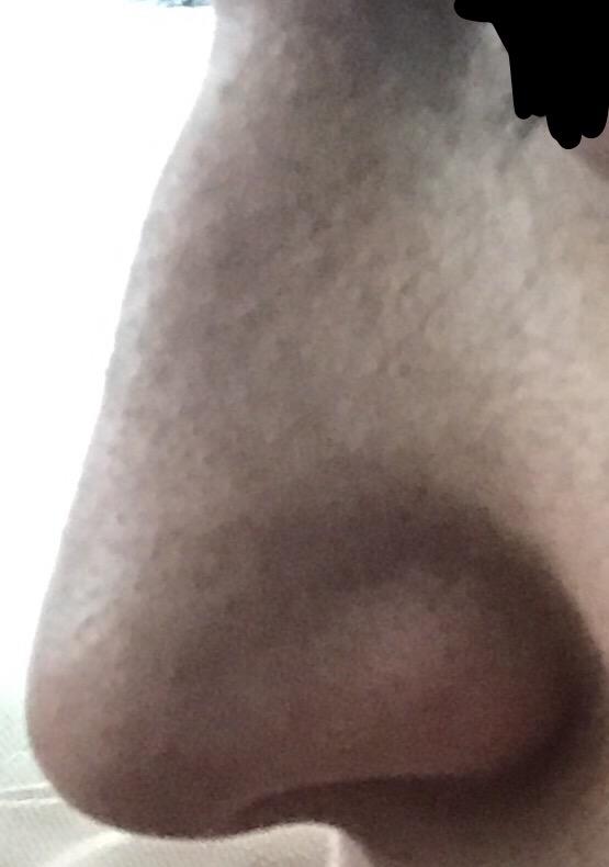 Burnum çok mu çirkin? Estetik yaptırayım mı sizce ?
