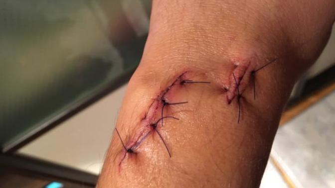 Ganglion kisti ( yağ bezesi ) ameliyatı sonrası. Bu iz nasıl geçer?