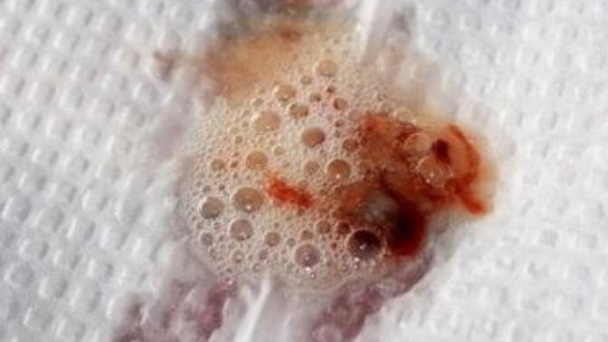 Kanlı balgam gelmesi sorun yaratır mı?