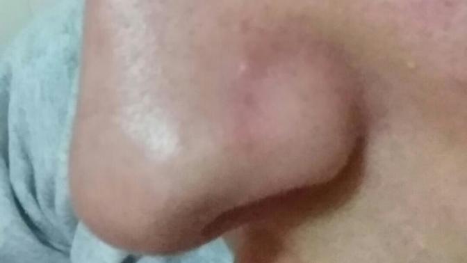 Burnumda görünen şey yıllardır var, renksiz sivilce gibi ama sıkılmıyor da. Yağ bezesi olabilir mi ve aldırabilir miyim cerrahi?