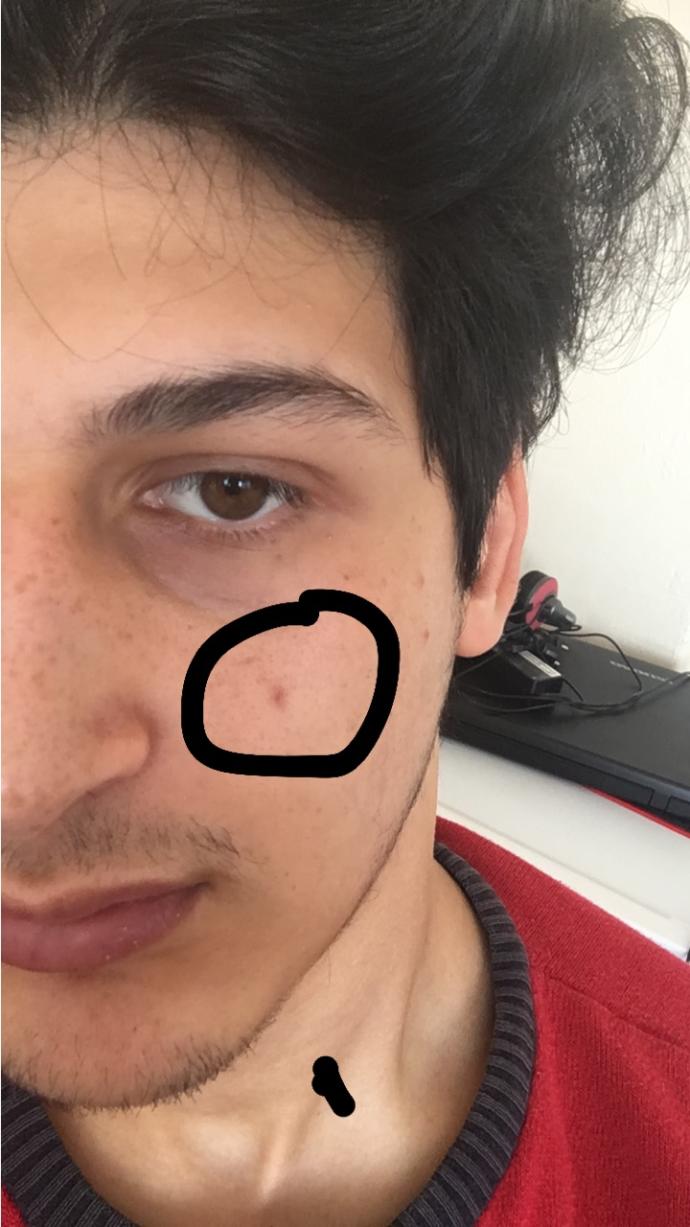 Suratımda siyah nokta çıktı ve ben onu sıktım kızardı ve şiştı bıraz bu siyah nokta ben olur mu?