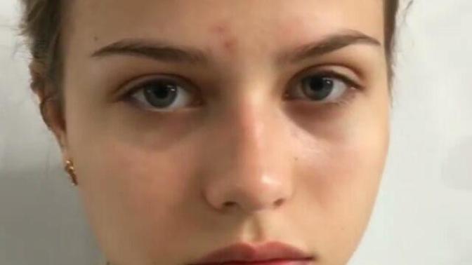 Çok sık peeling yapmak sivilce yapar mı? Tecrübelerinizi paylasın? :) ! ?