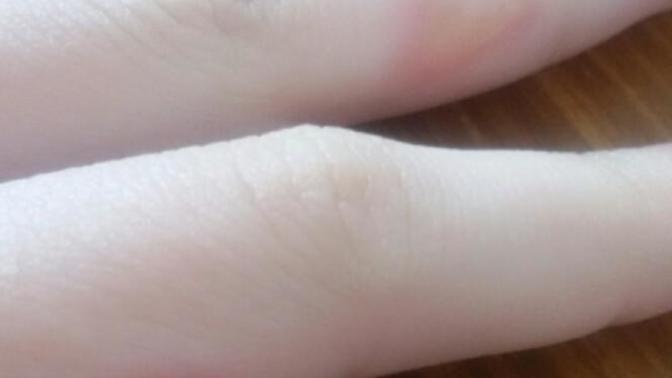 Elimi yaktım bilgisi olanlar (fotoğraflı)?