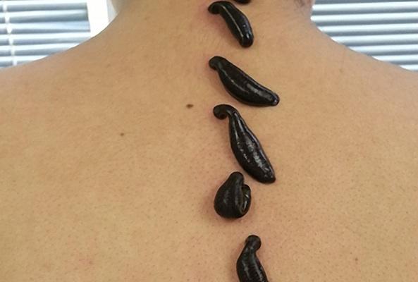 Tıbbi sülük tedavisinin insan vücuduna faydalarını biliyor musunuz? Hiç sülük tedavisi yaptırdınız mı?