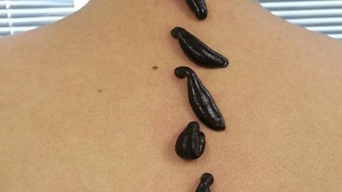 Tıbbi sülük tedavisinin insan vücuduna faydalarını biliyor musunuz? Hiç sülük tedavisi yaptırdınız mı?