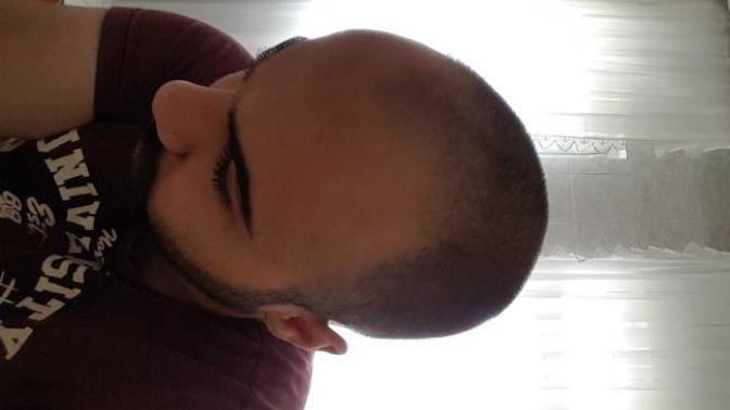 Sizce saç ektirmeli miyim?