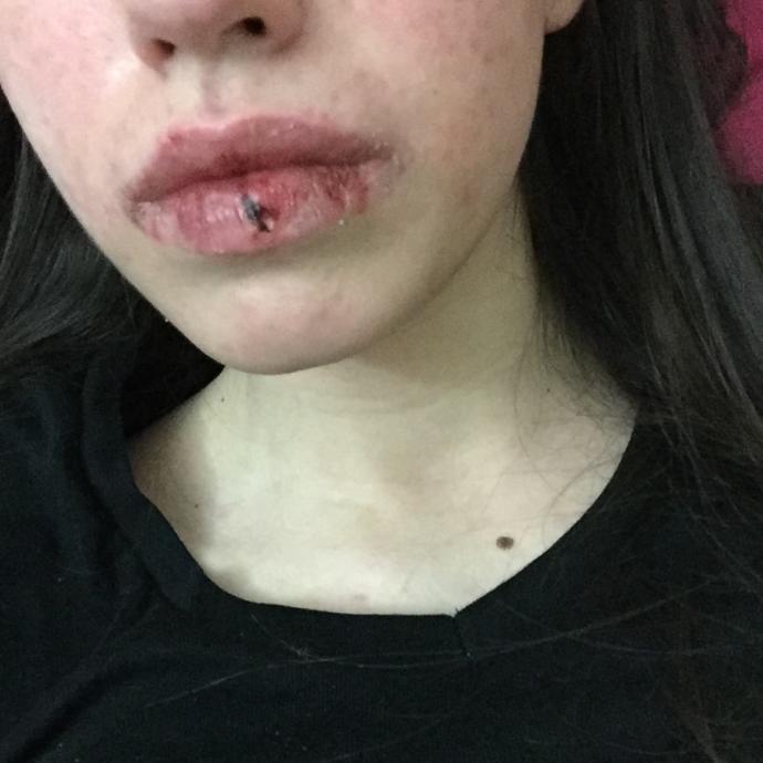 Sivilce lekesi çalışmama engel mi ?