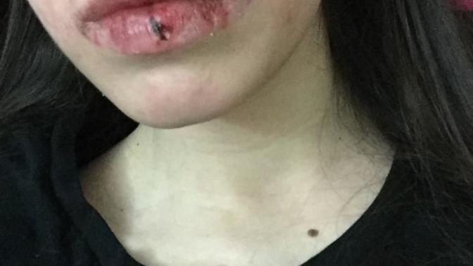 Sivilce lekesi çalışmama engel mi?