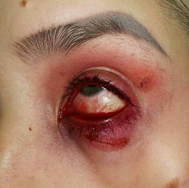 Göz neden kanar arkadaslar?