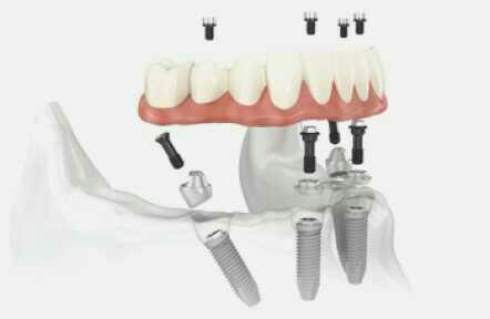 dental implant yaptırmak isteyenler ? süreci biliyor musunuz ??