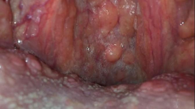 Faranjit nasıl oluyor?