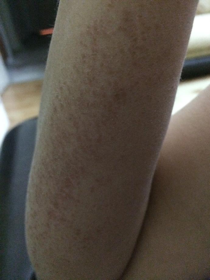 Roaccutane mağduru!?!!?