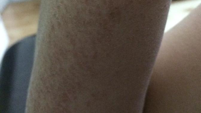 Roaccutane mağduru?