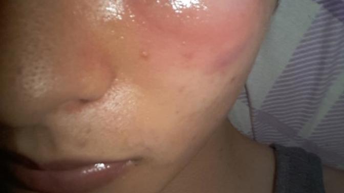 GOZUMUN ALTI ŞIŞTI RESIMLI LUTFEN YARDIM?