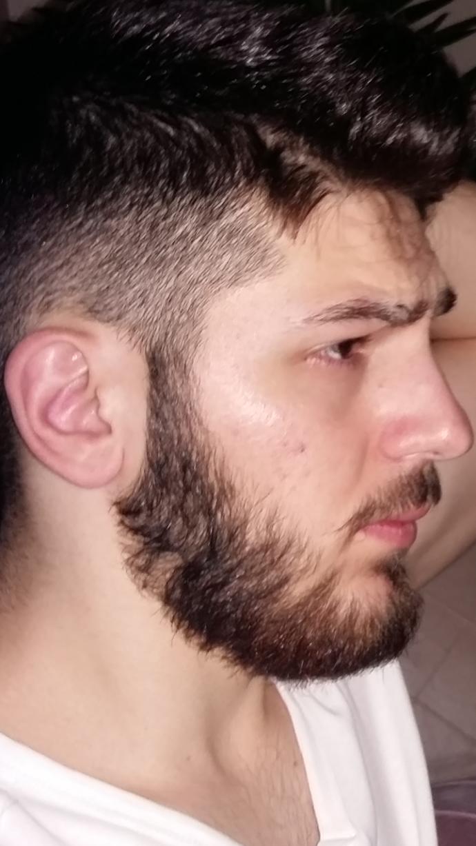 Arkadaşlar şu sivilce lekeleri nasıl geçer ☡⬆⬆ ?