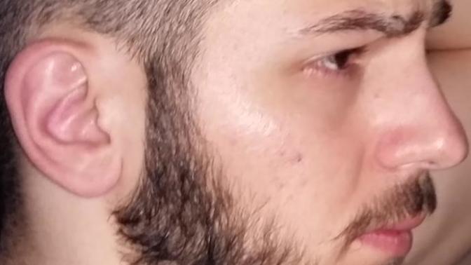 Arkadaşlar şu sivilce lekeleri nasıl geçer ☡⬆⬆ ?