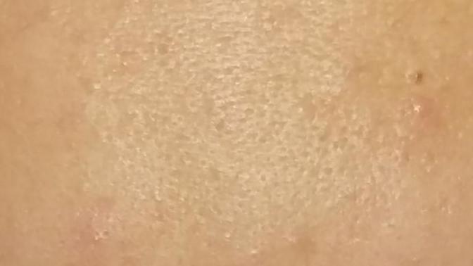 Kızlar, Bunlar gözenek mi yoksa sivilce siyah nokta sıkmaktan dolayı oluşan çukurlar mı?