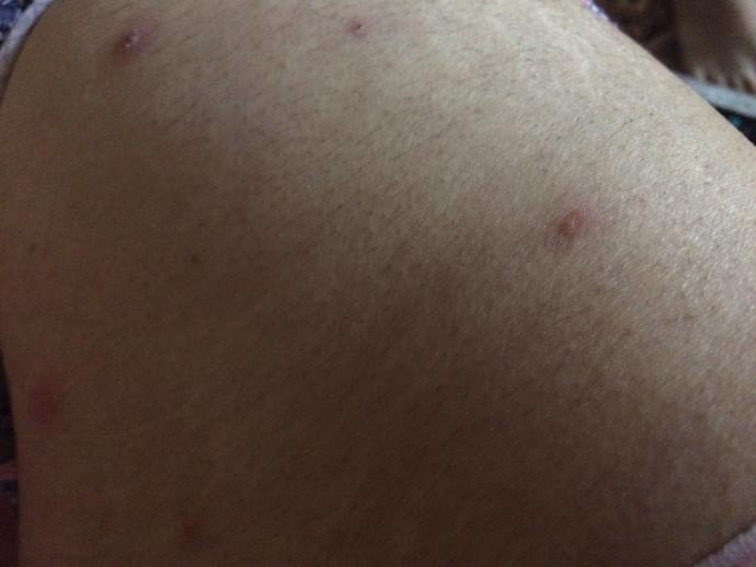 Çiban mi bunlar arkadaslar her gun yenisi cikiyo yardim Allah askina ?