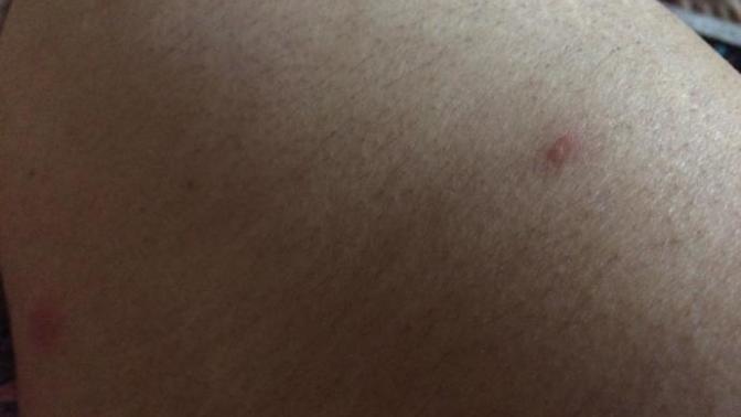 Çiban mi bunlar arkadaslar her gun yenisi cikiyo yardim Allah askina?