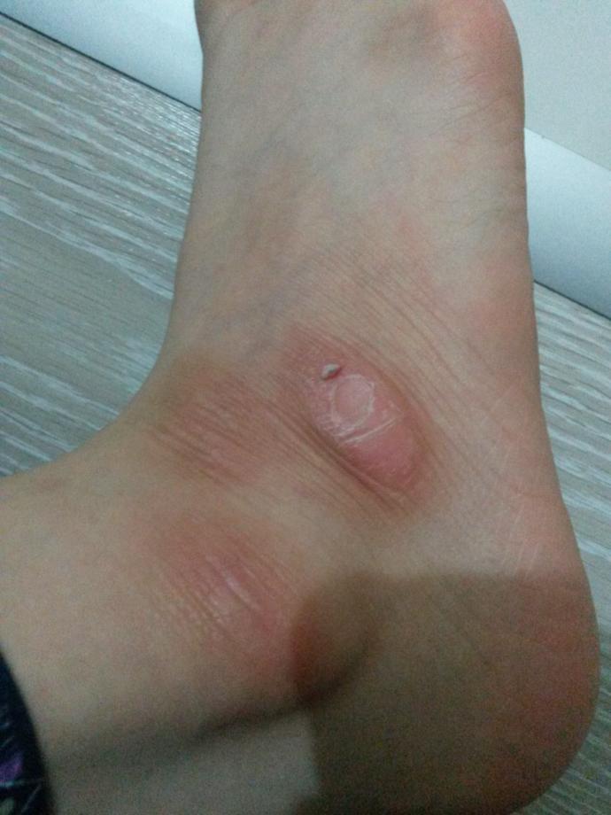 Ayagimdaki bu kabuklanma?