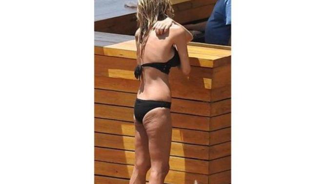 İrem Derici zayıf olmasına rağmen nasıl selüliti var?